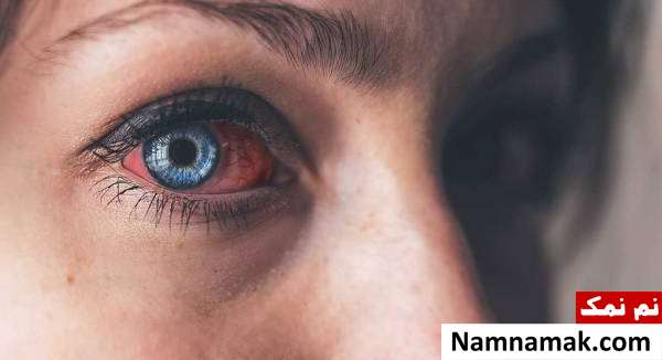 عفونت و قرمزی چشم
