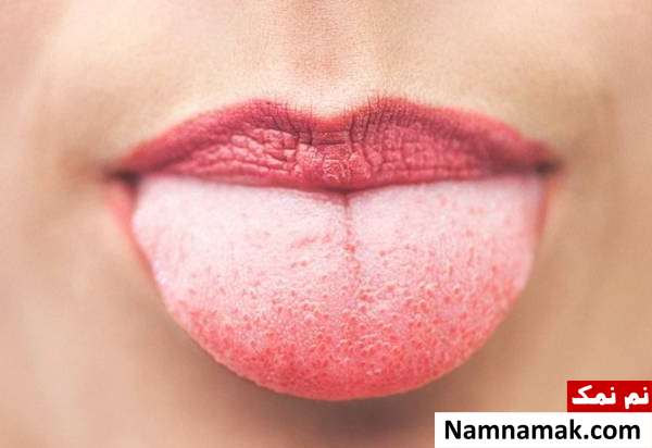 بیماری های خاص زبان