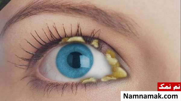 علت انواع ترشح چشم و بیماریهای مرتبط با رنگ ترشح چشم ترشح چشم و سلامتی