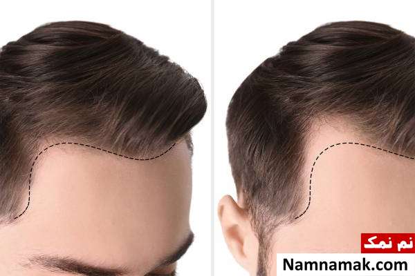 تغذیه بعد از کاشت مو