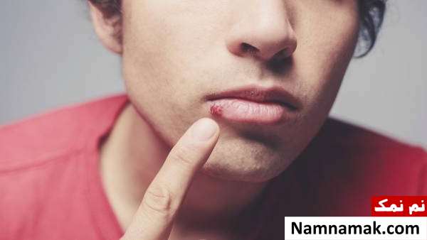 18 خواص و فایده ویتامین e برای جلوگیری از سفیدی مو و پیری پوست ویتامین برای تبخال