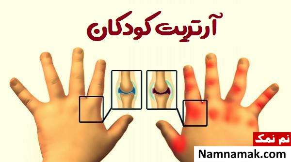 آرتریت و ورم مفاصل در کودکان