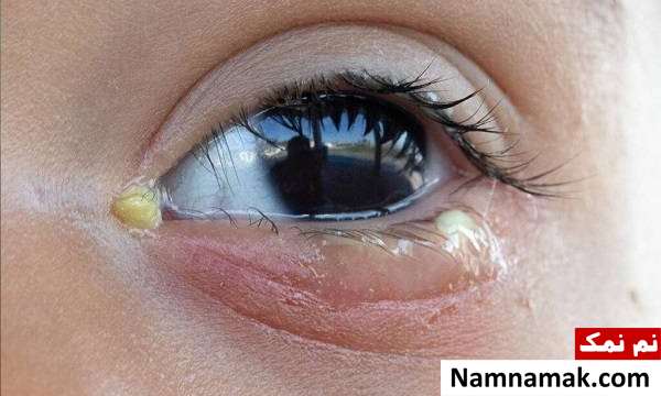 ترشحات چشمی که دلیل آنها باید جدی است علل ترشحات چشمی
