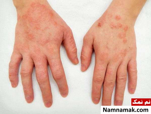 دلیل خشکی پوست دور چشمم چیه؟ + درمان فوری مشکلات پوستی و خشکی پوست دور چشم