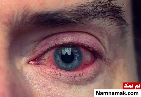 دلیل خشکی پوست دور چشمم چیه؟ + درمان فوری پوسته پوسته شدن پلک ها