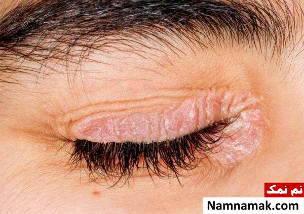دلیل خشکی پوست دور چشمم چیه؟ + درمان فوری پسوریازیس و خشکی پوست اطراف چشم