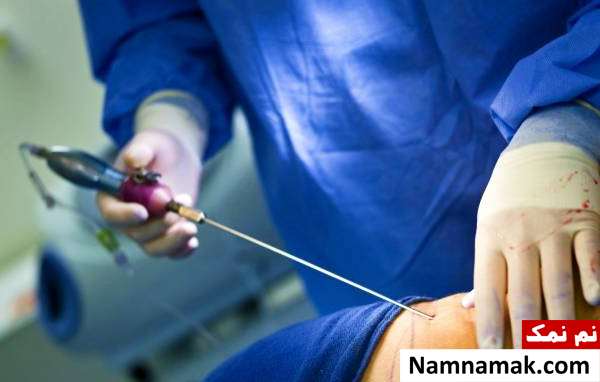 برداشتن چربی های اضافه بدن