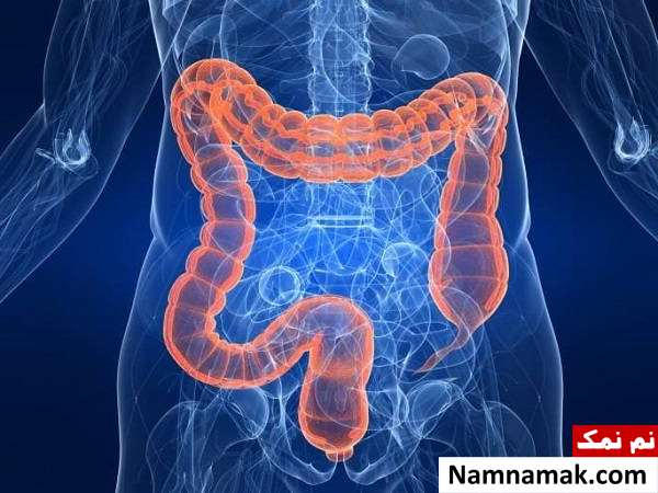 همه چیز درباره سندرم لینچ ، از علل و علائم تا درمان و عوارض بیماری سندرم لینچ