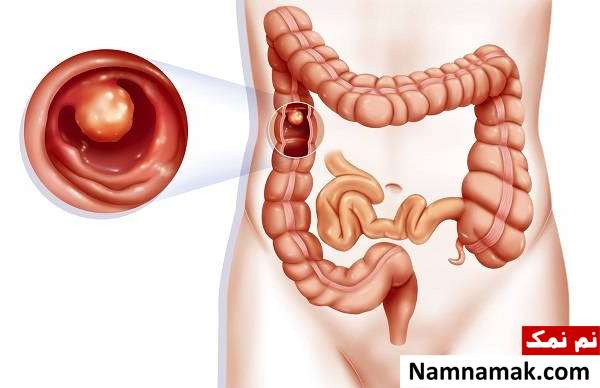 همه چیز درباره سندرم لینچ ، از علل و علائم تا درمان و عوارض علل بیماری سندرم لینچ