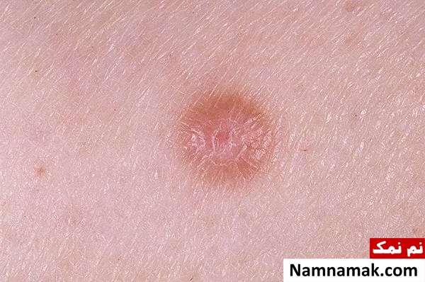 درماتوفیبروم چیست؟علل و درمان توده های روی پوست علائم درماتوفیبروما