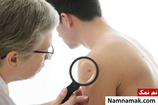 درماتوفیبروم چیست؟علل و درمان توده های روی پوست تشخیص و درمان درماتوفیبروم