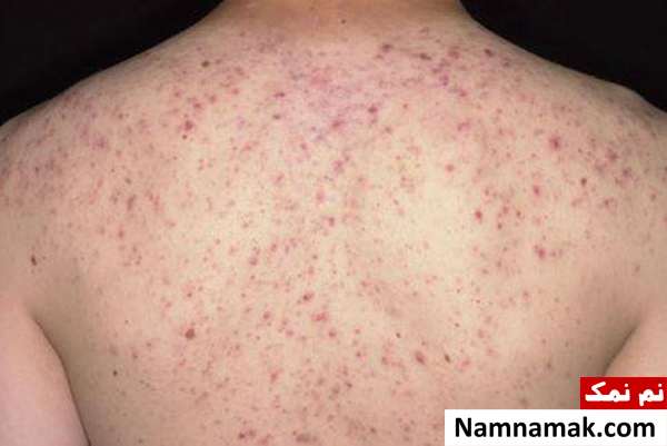 جوش پشت کمر نشانه چیست؟ جوش پشت کمر