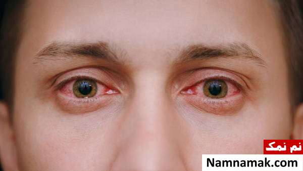 انواع مشکلات چشمی و علل هرکدام + نوع خطرناک علت چشم های قرمز