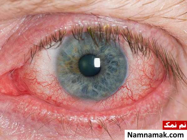 انواع مشکلات چشمی و علل هرکدام + نوع خطرناک یوئیت چشم