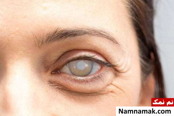 انواع مشکلات چشمی و علل هرکدام + نوع خطرناک آب مروارید به چه علت است؟