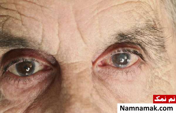انواع مشکلات چشمی و علل هرکدام + نوع خطرناک گلوکوم چشم چیست