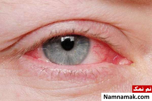 انواع مشکلات چشمی و علل هرکدام + نوع خطرناک ورم ملتحمه چشم چیست