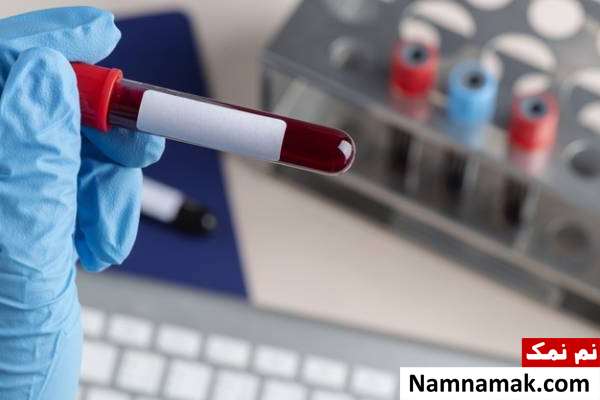 گواتر چیست؟ از علل و علائم تا تشخیص و درمان + عوارض تشخیص تیروئید با آزمایش هورمونی