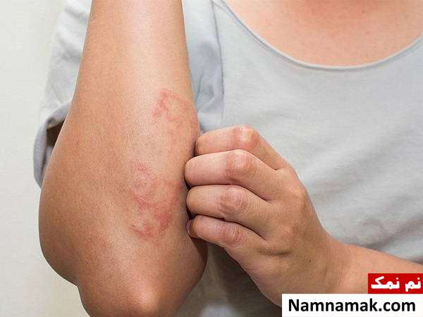 ابتلا به کهیر و آنژیوادم