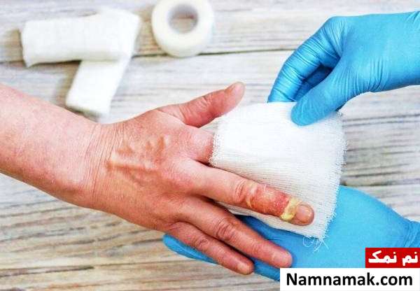 اقدامات اولیه برای درمان سوختگی شدید