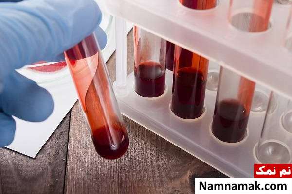 انواع آنژیوادم ارثی + علائم ، تشخیص و درمان تشخیص آنژیوادم ارثی