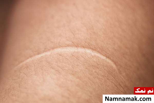 ویژگی های کلوئید اسکار 
