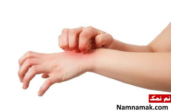 علت های کلوئید اسکار 