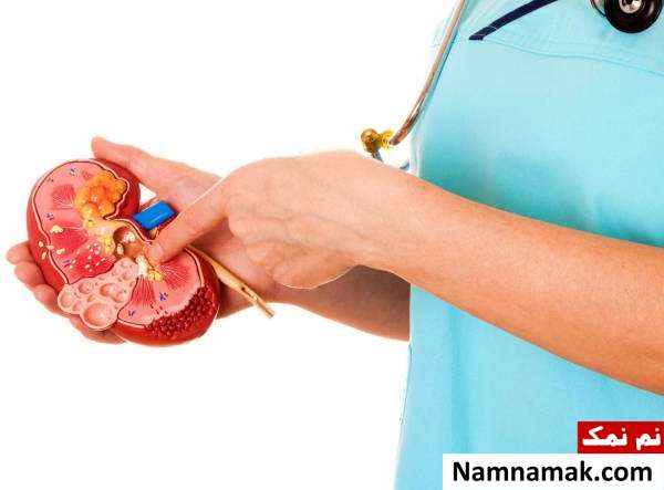 بیماریهایی که خانم ها بعد 30 سالگی دچار میشن! سنگ کلیه در زنان 30 سال به بالا
