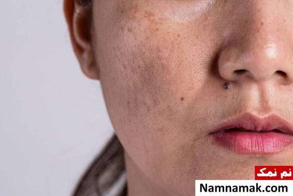 بیماریهایی که خانم ها بعد 30 سالگی دچار میشن! هایپرپیگمنتیشن مشکل پوستی بعد از 30 سال