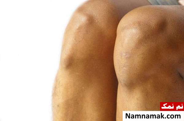 علت اصلی آب آوردن زانو چیست؟ + پیشگیری و درمان جراحت از علل ورم و آب آوردن زانو