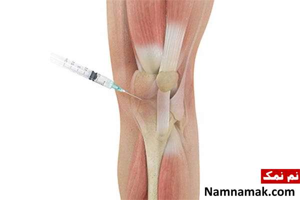 همه چیز درباره تزریق هیدروکورتیزون به زانو و ... + عوارض محل تزریق کورتیزون