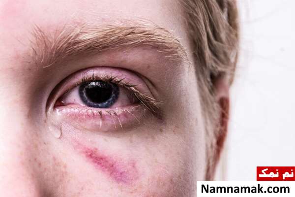 کمک های اولیه چشم ؛ ضربه ، خراش ، سوختگی و ... حین سوراخ شدن چشم چیکار کنیم؟