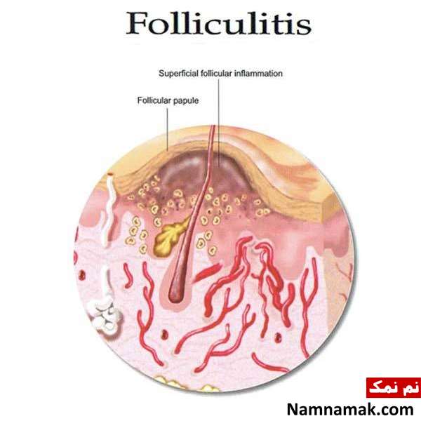 عوارض و مضرات اپیلیدی ناحیه تناسلی