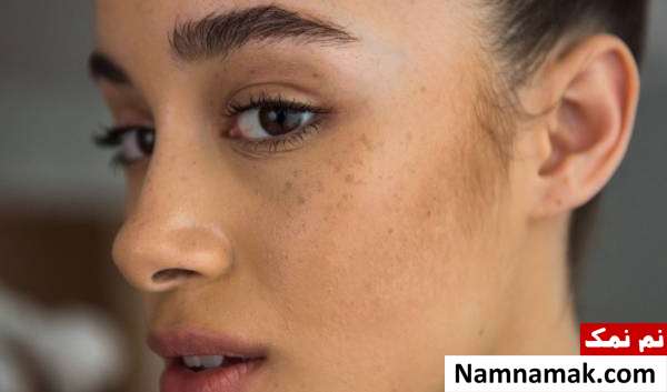 علت لکه قهوه ای روی پوست