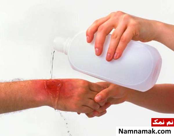 کمک های اولیه سوختگی در خانه تکانی