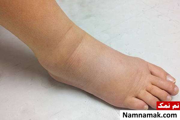 8 دلیل علم پزشکی ورم پاها دلیل ورم پا