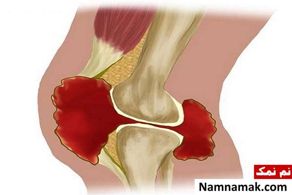 کمک اولیه شکستگی + علائم انواع شکستگی خونریزی از عوارض شکستگی استخوان