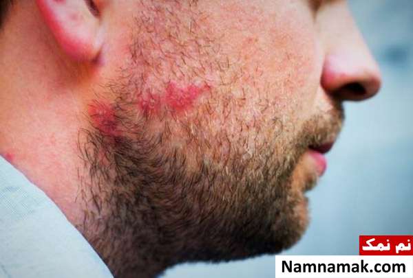 مشکلات و بیماری های رایج ریش مردان آکنه از بیماری های پوستی ریش مردان