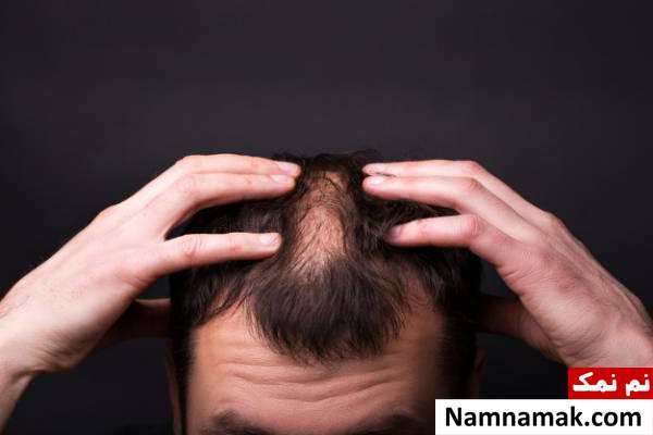 تاثیر بی خوابی بر ریزش مو