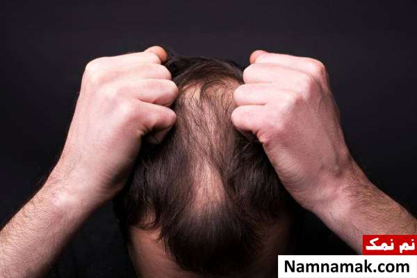 ریزش مو بر اثر بی خوابی