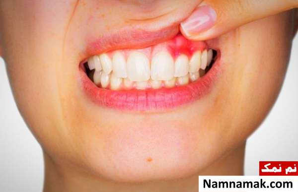 ارتباط زخم های دهان و حساسیت دهانی با کووید 19