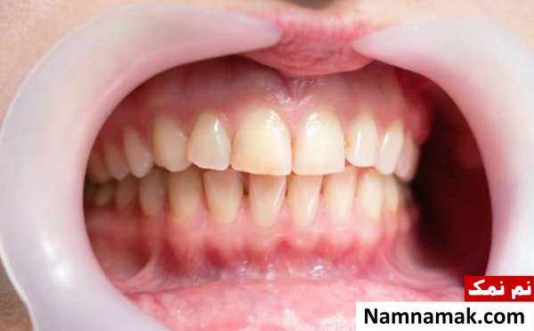 بیماری پریودنتال از نشانه های عفونت در دهان