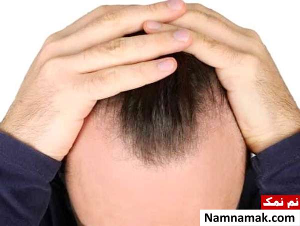 دلیل ریزش موی نوجوان پسر و دختر + درمان خانگی دلایل اصلی ریزش مو در سنین نوجوانی