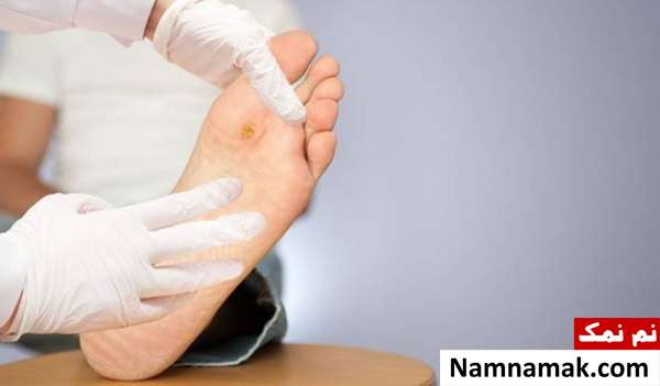 علائم پیشرفت دیابت که باید جدی گرفت زخم های ایجاد شده ناشی از دیابت