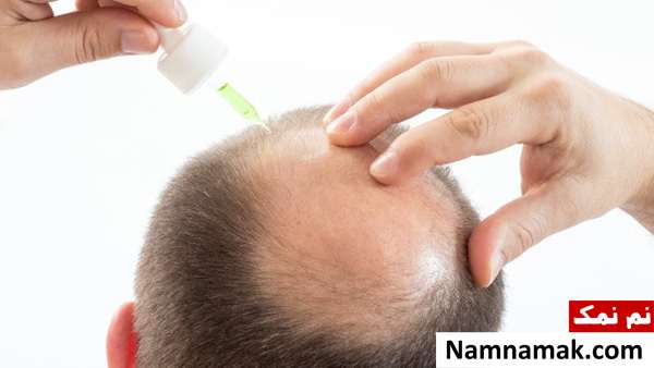 آیا ماینوکسیدیل شپش را نابود می کند؟ ماینوکسیدیل برای شپش