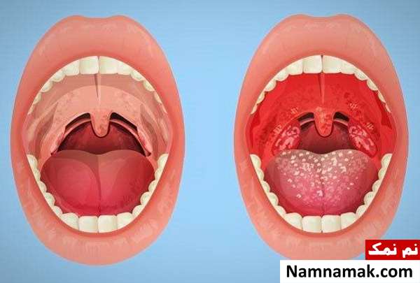 علائم بیماری های لوزه