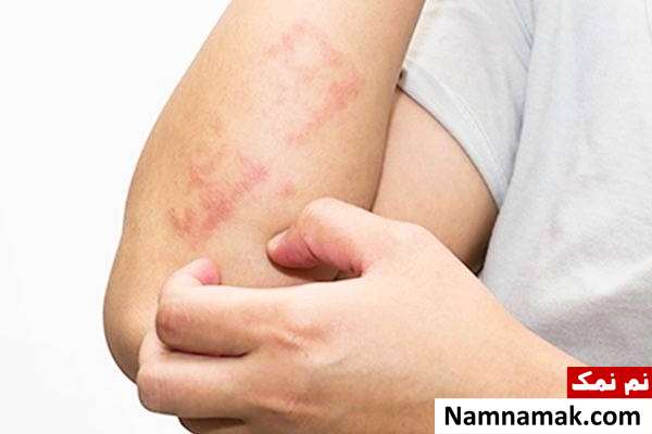 بدترین مشکلات پوستی ناشی از استرس + راه حل اگزما از عوارض استرس