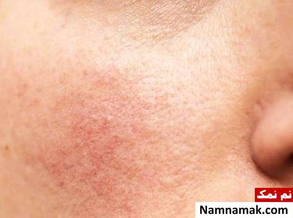 بدترین مشکلات پوستی ناشی از استرس + راه حل التهاب پوستی از علائم استرس