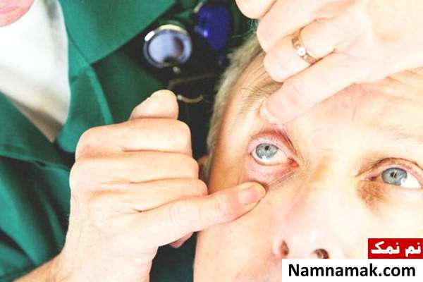 کمک های اولیه چشم ؛ ضربه ، خراش ، سوختگی و ... حین سوراخ شدن چشم چیکار کنیم؟