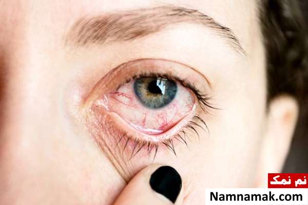 کمک های اولیه چشم ؛ ضربه ، خراش ، سوختگی و ... درمان ضربه به چشم